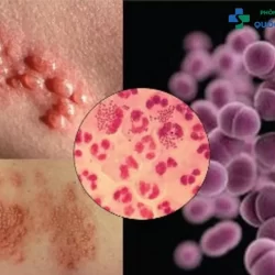 Bệnh lậu: Nguyên nhân, dấu hiệu, cách điều trị và biện pháp phòng ngừa