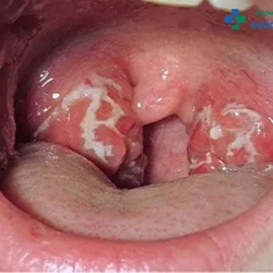 Những dấu hiệu, biến chứng bệnh lậu ở miệng chớ chủ quan!