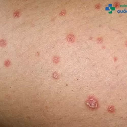 Chuyên gia giải đáp: “Bệnh lậu ở nữ giới khác gì bệnh lậu ở nam?”