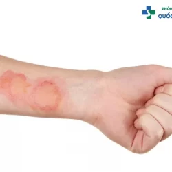 Nhận biết dấu hiệu bệnh lậu giai đoạn đầu càng sớm, hiệu quả điều trị càng cao