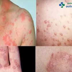 Bệnh lậu lây truyền qua đường nào, có phải chỉ mỗi quan hệ tình dục hay không?