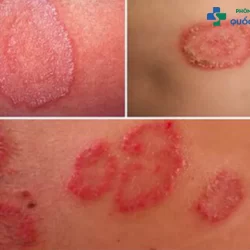 Cùng chuyên gia giải đáp: “Bệnh lậu mãn tính có chữa được không?” 