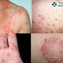 Tổng hợp những thông tin liên quan đến bệnh lậu và giang mai