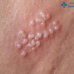 Làm thế nào để nhận biết biểu hiện của bệnh lậu? Bệnh có chữa được không?