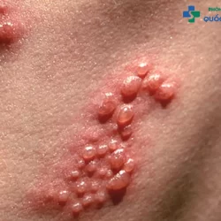 Các giai đoạn của bệnh lậu liệu bạn đã biết rõ chưa?