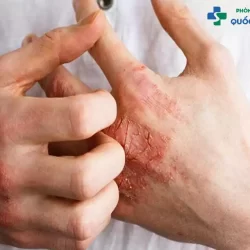 [TỔNG HỢP] Các cách chữa trị bệnh lậu như thế nào an toàn, hiệu quả