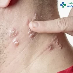 Bác sĩ chuyên khoa tiết lộ dấu hiệu bệnh lậu ở nam và cách điều trị hiệu quả