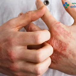 Hình ảnh bệnh lậu – Nhận biết dấu hiệu qua từng giai đoạn bệnh