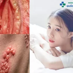 Bạn đã biết: Hình ảnh bệnh lậu ở nữ và những triệu chứng điển hình?