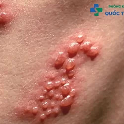 [Giải đáp] Bệnh lậu là gì mà ở nam giới và phụ nữ đều gặp?