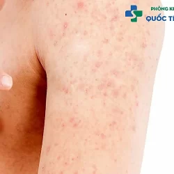 Bệnh lậu mãn tính có chữa trị dứt điểm được không?