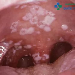 Chuyên gia tư vấn phương pháp điều trị bệnh lậu ở lưỡi hiệu quả 