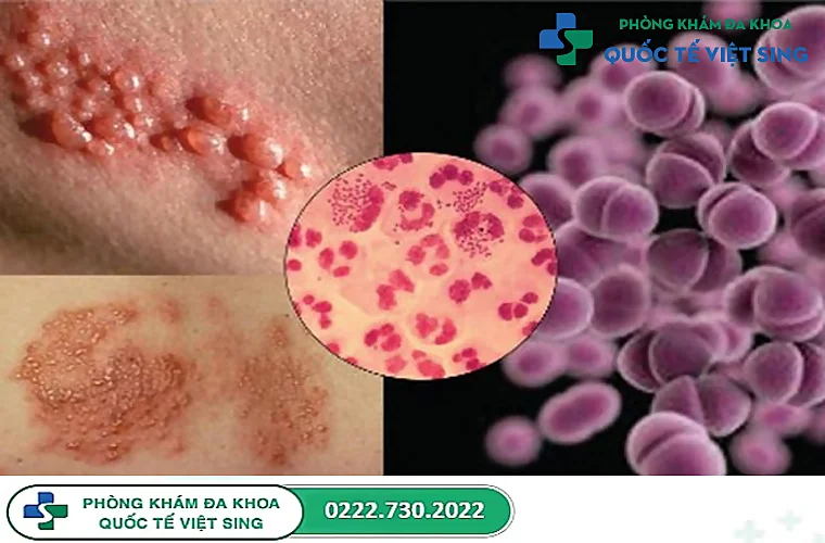 Hiểu đúng về bệnh lậu và cách chữa trị