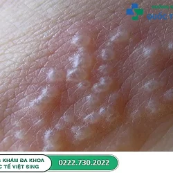 Những điều cần biết về mụn rộp sinh dục và cách điều trị bệnh hiệu quả