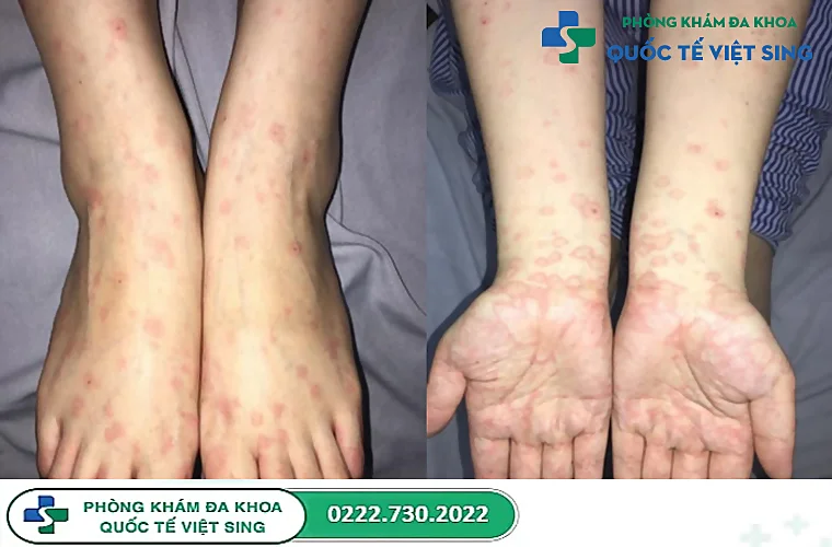 Nhận biết triệu chứng của herpes sinh dục có dễ không?