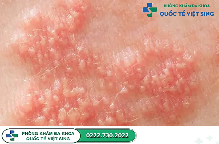 Biến chứng nguy hiểm của herpes sinh dục