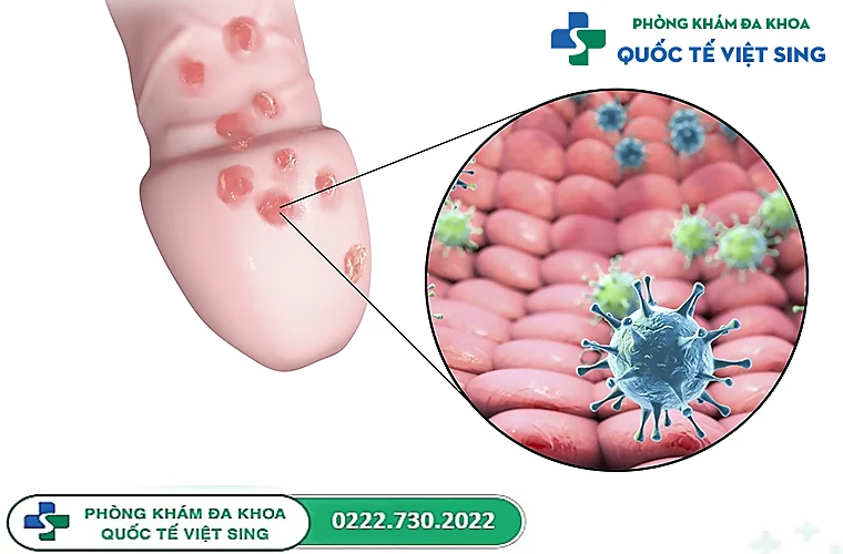 Mụn rộp sinh dục nam giới là bệnh gì?