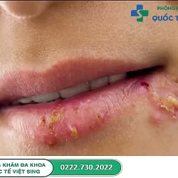 Đi tìm nguyên nhân gây ra mụn rộp sinh dục ở miệng và cách chữa hiệu quả