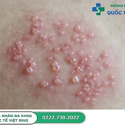 Nhận biết hình ảnh mụn rộp sinh dục và cách khắc phục hiệu quả