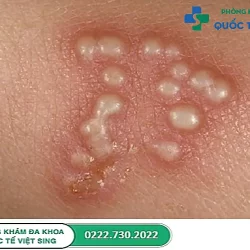 Hình ảnh mụn rộp sinh dục ở nữ – Phản ánh mức độ nghiêm trọng của bệnh 