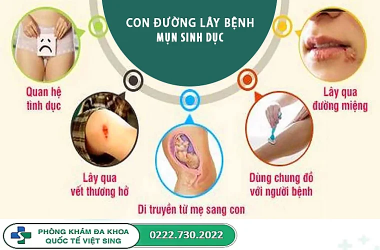 Những nguyên nhân lây nhiễm mụn rộp sinh dục bạn nên biết