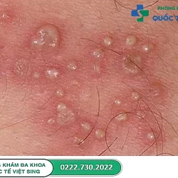 Cảnh giác dấu hiệu mụn rộp sinh dục giai đoạn đầu ở nam và nữ