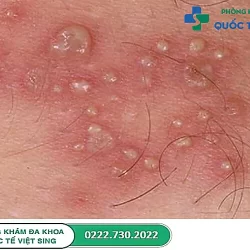 Mụn rộp sinh dục là gì? Nhận biết dấu hiệu và nguyên nhân gây bệnh 