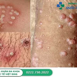Sử dụng thuốc bôi mụn rộp sinh dục nam và nữ cần lưu ý điều sau!