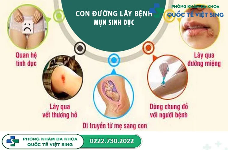 Con đường lây truyền bệnh mụn rộp sinh dục