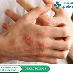 Biến chứng mụn rộp sinh dục có nguy hiểm không? Khắc phục như thế nào?