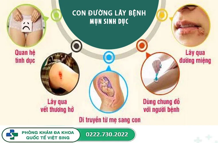 Đường lây truyền của bệnh mụn rộp sinh dục là gì?