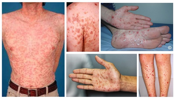 Top 10 địa chỉ Phòng khám xét nghiệm giang mai Bắc Ninh [Cập nhật 2025]