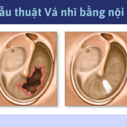 [Tham khảo] Top 10 địa chỉ phòng khám vá màng nhĩ Bắc Ninh – nhiều người khám
