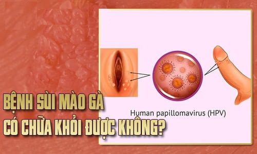 Sùi mào gà có chữa khỏi được không? Hé lộ phương pháp giúp hàng ngàn người thoát bệnh