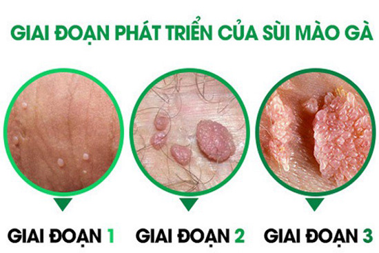 Top 10 địa chỉ phòng khám sùi mào gà Bắc Giang uy tín, chất lượng