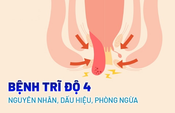 Trĩ cấp độ 4: Khi bệnh đã ở giai đoạn nặng nhất – Làm sao để xử lý kịp thời?