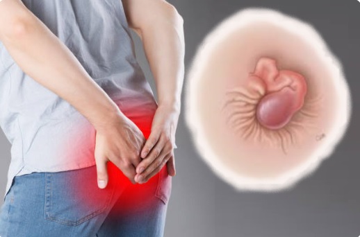 Bị trĩ lòi ra ngoài phải làm sao? Bí quyết chuyên gia tiết lộ ít ai biết