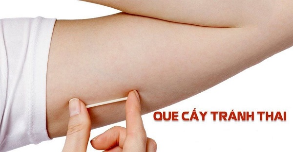 Top 10 địa chỉ Phòng khám cấy que tránh thai Bắc Ninh