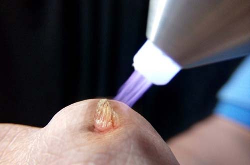 [Giải đáp] Đốt điện sùi mào gà bao nhiêu tiền và có đáng để lựa chọn hay không?