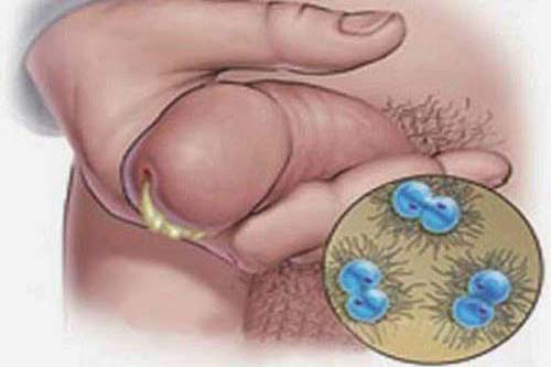 Dương vật bị đau và chảy mủ cảnh báo bệnh gì? Chờ chủ quan kẻo biến chứng nguy hiểm