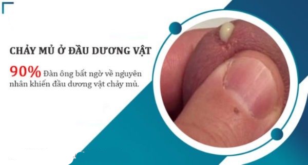 Dương vật chảy mủ xanh – Xin đừng chủ quan