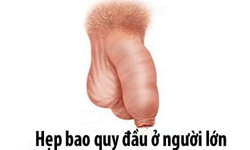 Tìm hiểu nguyên nhân hẹp bao quy đầu ở người lớn và cách xử lý hiệu quả