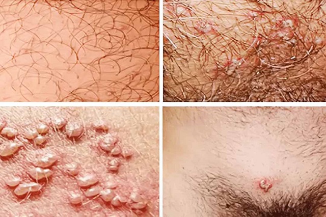 Bị mọc mụn vùng kín, đừng chủ quan! Gợi ý nơi chữa vùng kín mọc mụn Bắc Ninh an toàn, kín đáo