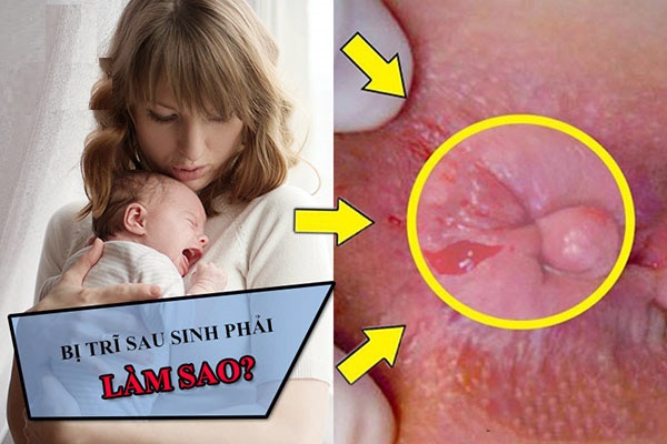 Mới sinh xong bị trĩ phải làm sao? Bác sĩ chỉ rõ cách xử lý an toàn cho mẹ bỉm