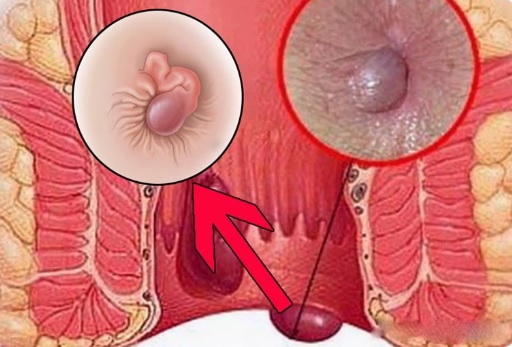 [Bỏ túi] Cách giảm sưng đau búi trĩ nhanh chóng – Bác sĩ cảnh báo sai lầm thường gặp