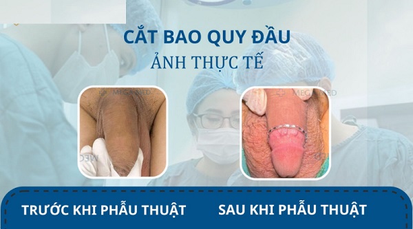 [Bật mí] Top 10 địa chỉ phòng khám cắt bao quy đầu Bắc Giang