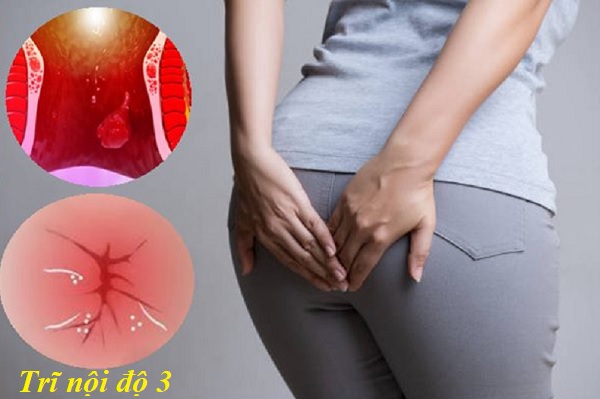 Trĩ nội độ 3: Nguyên nhân, triệu chứng và cách điều trị hiệu quả