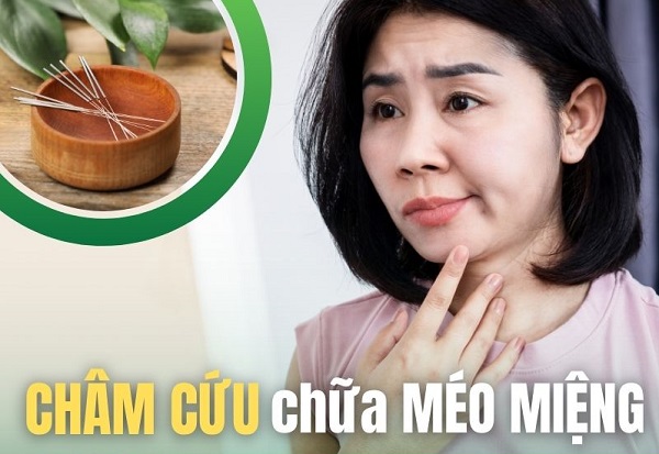 Méo miệng sau tai biến bao lâu thì châm cứu có tác dụng?