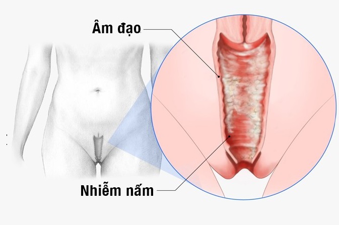 Đừng để nấm âm đạo tái phát liên tục – Chọn đúng nơi chữa nấm âm đạo ở Bắc Ninh để dứt điểm!