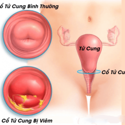 Chữa viêm cổ tử cung Bắc Ninh: Đâu là địa chỉ uy tín, an toàn nhất